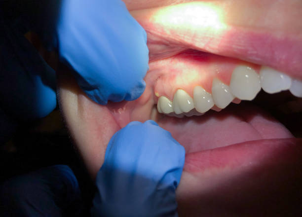 Best Emergency Wisdom Teeth Removal in The Acreage, FL